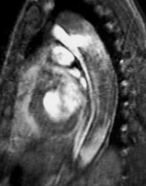 Sagittal gradient-echo MRI image obtained in early