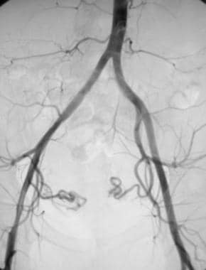 Nonselective pelvic angiogram demonstrating the to