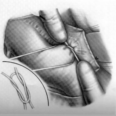 Patent Ductus Arteriosus Surgery. Ligation of pate