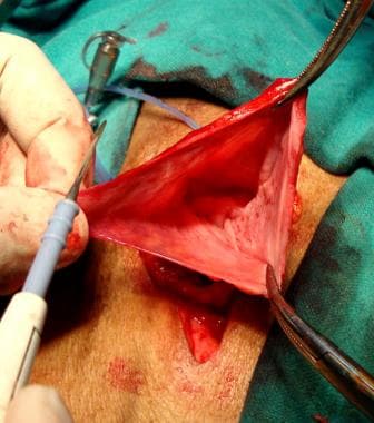 Open inguinal hernia repair. Anterior wall of dist