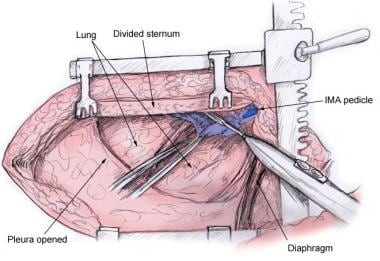 Coronary Artery Bypass Grafting. Illustration of a