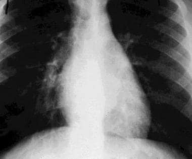 Plain chest radiograph showing a left paraspinal m