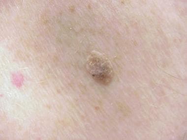 inflamed seborrheic keratosis