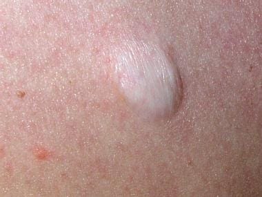 Close-up view of a single lesion of anetoderma. 
