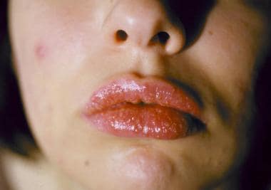 Acute allergic stomatitis involving the oral mucos