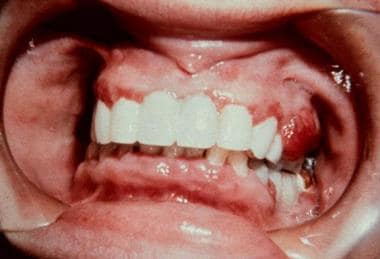 A large pedunculated mass on the gingiva resembles