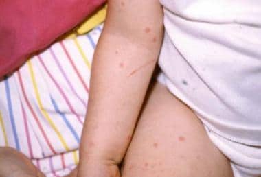 Bedbug bites themselves are typically painless. Ho