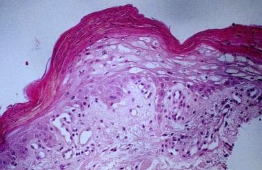 Acanthosis with upper epidermal necrolysis from a 