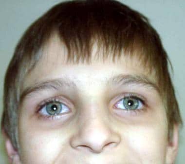 Face of a boy with ataxia-telangiectasia. Apparent