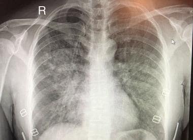 High-altitude pulmonary edema (HAPE). Plain chest 