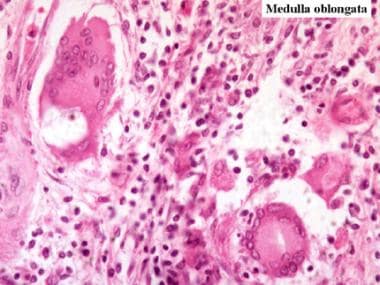 Noncaseating granuloma surrounded by epithelioid c