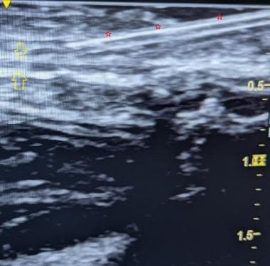 Long-axis view of needle entering soft tissue and 
