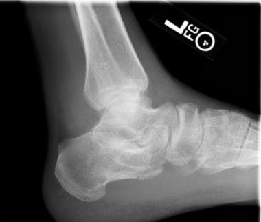 anterior calcaneus fracture