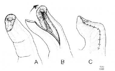 Diagram of a Moberg volar advancement flap being u