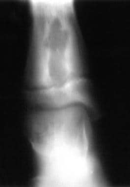 Anteroposterior radiograph of the distal tibia. Th