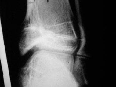 Growth plate (physeal) fractures. Follow-up radiog