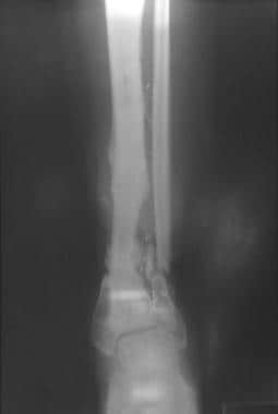 Clinical Case 2. Late postoperative radiograph. An