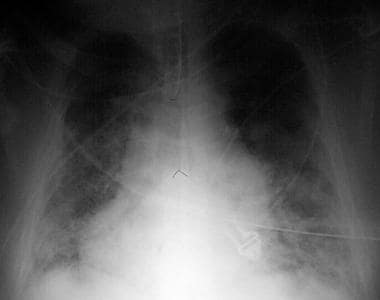 Portable chest radiograph of a 50-year-old man wit