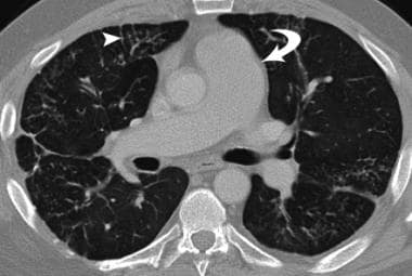 Pulmonary veno-occlusive disease in a 43-year-old 