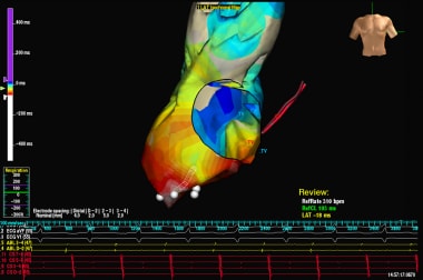 Atrial tachycardia. An anterior-posterior mapping 