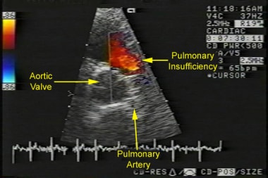 Pulmonic Stenosis. Echocardiogram of a patient wit