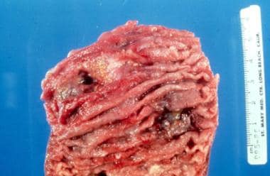 Gross specimen of bowel showing ulceration seconda