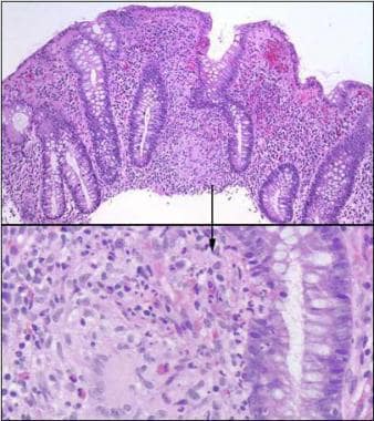 Inflammatory bowel disease. Colonic granuloma in a