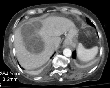 Computed tomography (CT) appearance of biliary cys