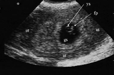 An endovaginal sonogram reveals an intrauterine pr