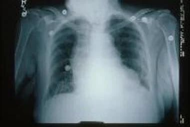 Chest radiograph shows signs of congestive heart f