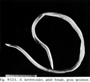 Adult Ascaris lumbricoides.
