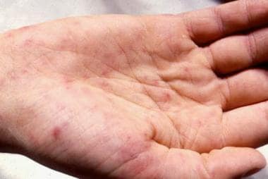 Petechiae on the palm. Courtesy of Professor Chien