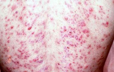 Cutibacterium infection. Nodular-cystic acne. 
