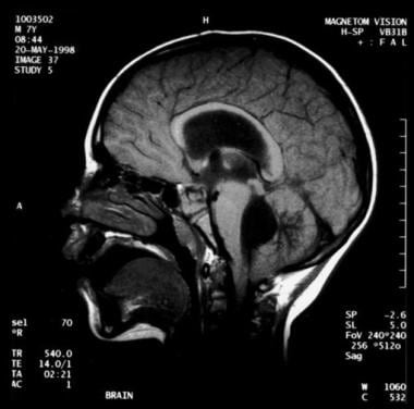 Noncommunicating obstructive hydrocephalus caused 