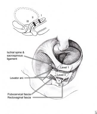 Enterocele and massive vaginal eversion. Levels of