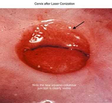 Cervix after laser conization. 