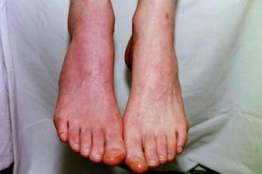 This photo shows the same patient as in the above 