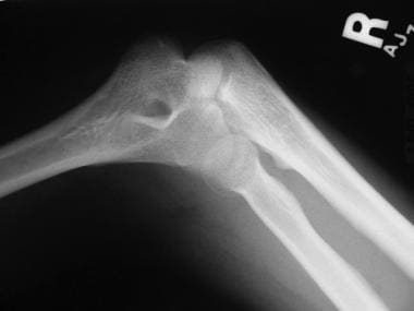 Osteoarthritis of the elbow is not commonly seen; 