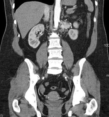 Same patient as in the previous image; CT angiogra