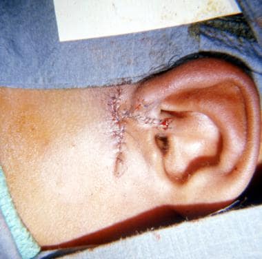 preauricular pit infection