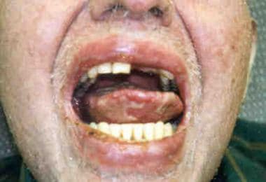 Oral mucosal changes in a patient with chronic gra