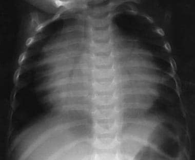 Plain chest radiograph in a 2-year-old boy with vi