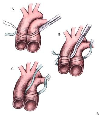 Braz J Cardiovasc Surg - The pulmonary vascular blood supply in the  pulmonary atresia with ventricular septal defect and its implications in  surgical treatment