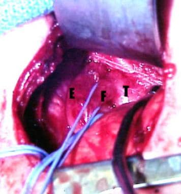 Intraoperative photograph demonstrating proximal H