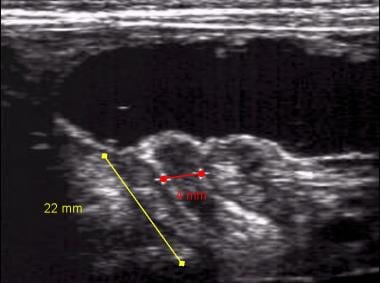 Longitudinal ultrasonogram of pyloric stenosis. Py