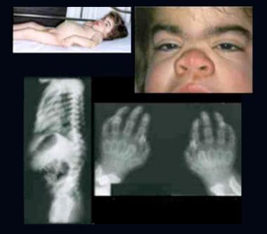 Child with Hurler syndrome (mucopolysaccharidosis 