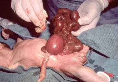 Pediatric omphalocele and gastroschisis (abdominal