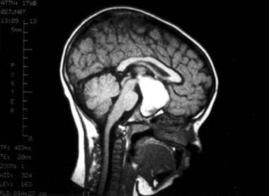 This MRI sequence was obtained following the intra