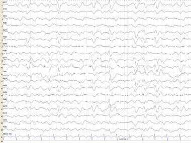 creutzfeldt jakob disease eeg