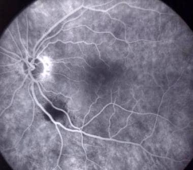 Fluorescein angiogram photograph taken 3 weeks aft